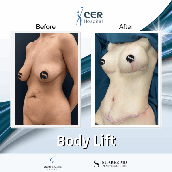 Body Lift - 125 - Image 7