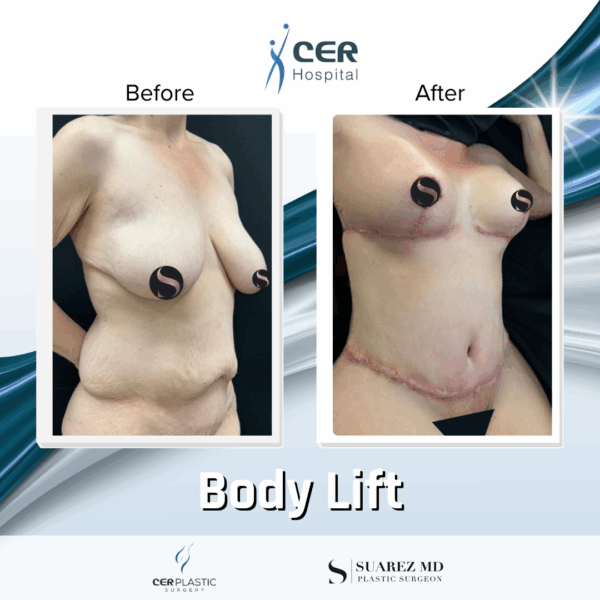 Body Lift - 165 - Image 7