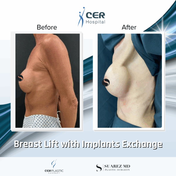 Breast Lift with Implants Exchange - 214 - Image 6