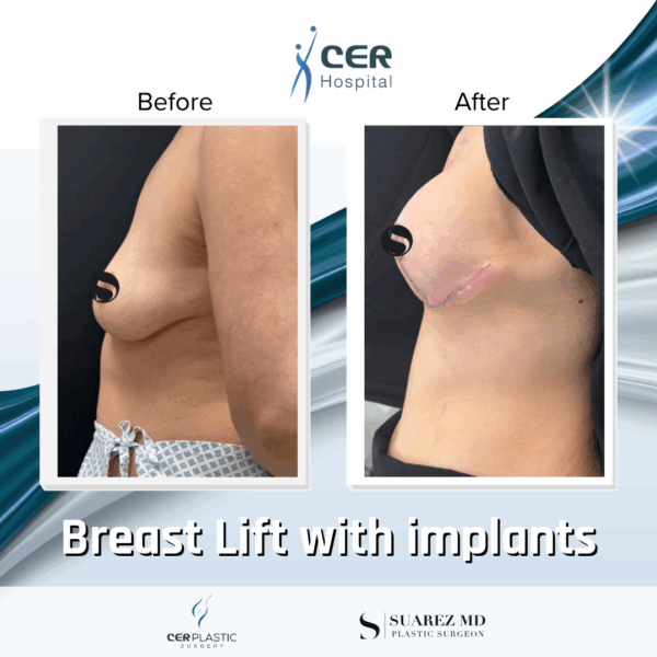 Breast Lift with Implants - 263 - Image 6