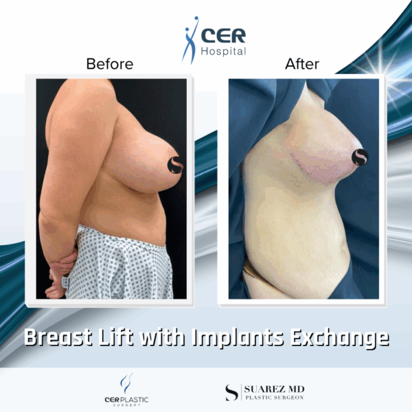 Breast Lift with Implants Exchange - 101 - Image 6
