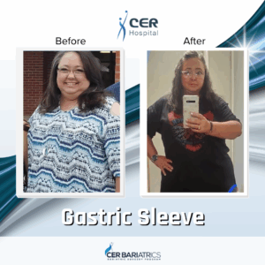 Gastric Sleeve
