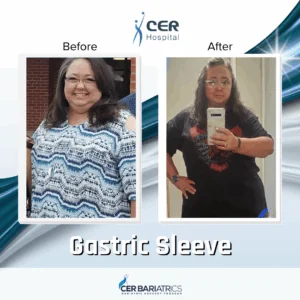 Gastric Sleeve