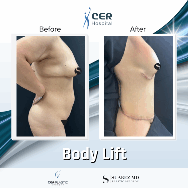 Body Lift - 213 - Image 6