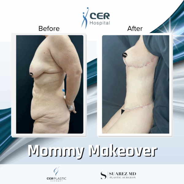 Mommy Makeover - 311 - Image 9