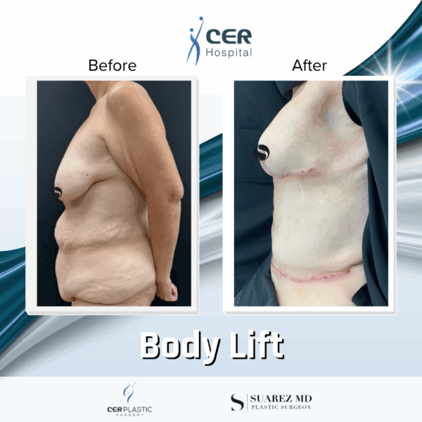 Body Lift - 075 - Image 7