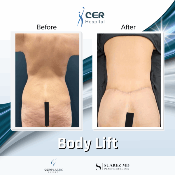 Body Lift - 304 - Image 6