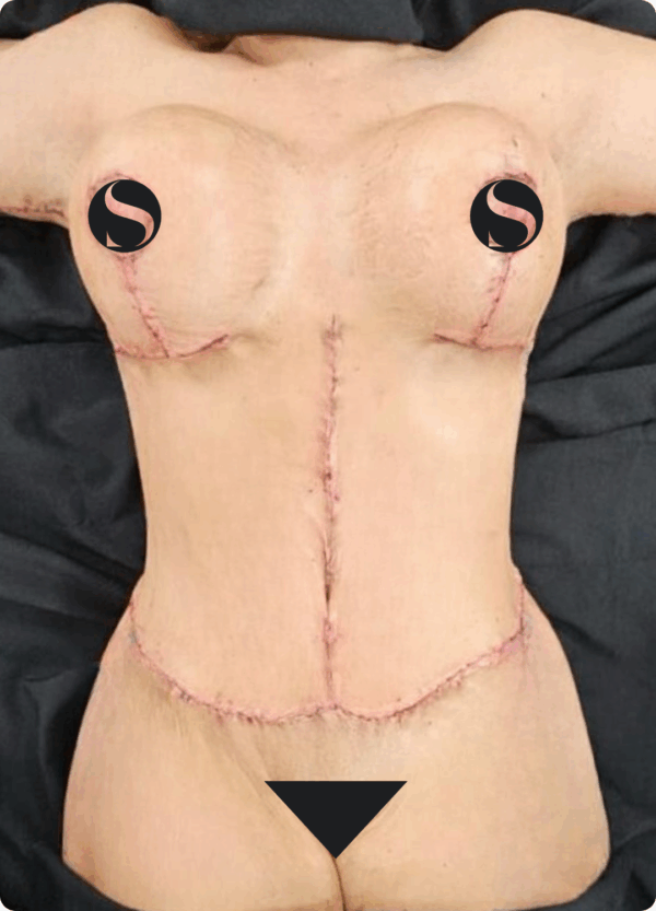 Body Lift - 304 - Image 2