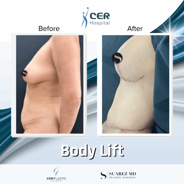 Body Lift - 234 - Image 7
