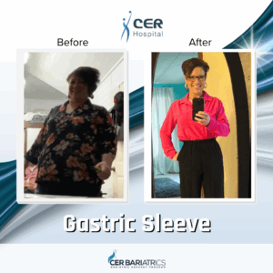 Gastric Sleeve