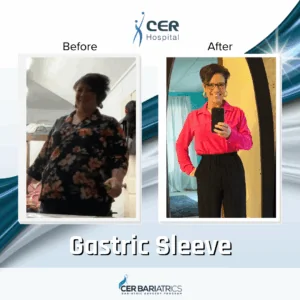 Gastric Sleeve