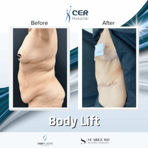 Body Lift – 144