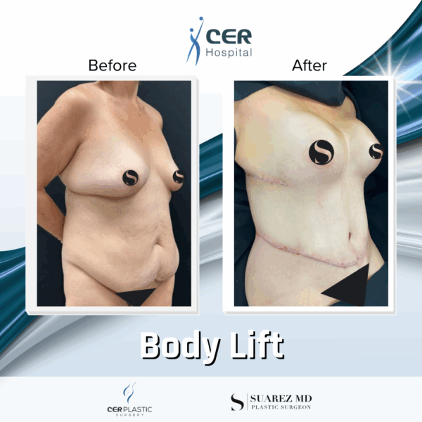 Body Lift - 037 - Image 5