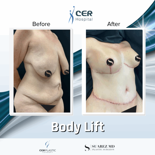 Body Lift -2094 - Image 7