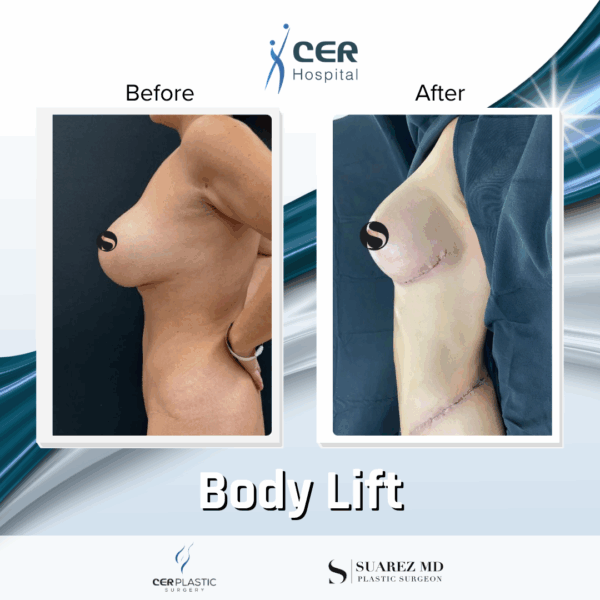 Body Lift -7104 - Image 7