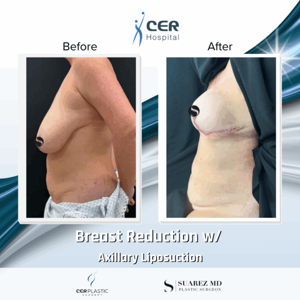 Breast Reduction and Axillary Liposuction - 042 - Image 7