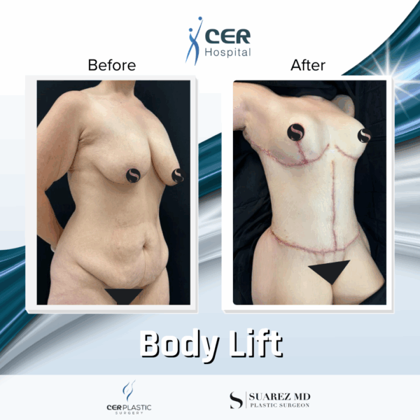 Body Lift - 26064 - Image 7