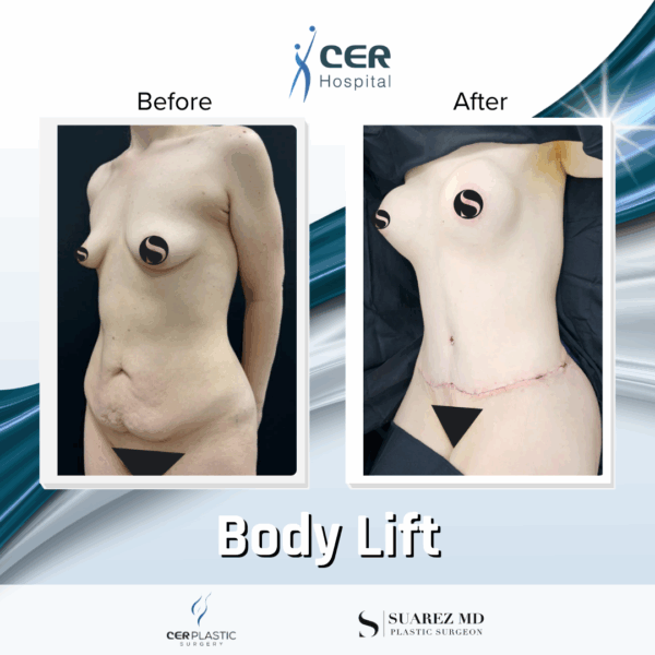 Body Lift - 19064 - Image 6
