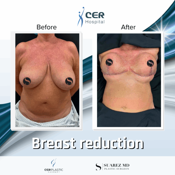 Breast Reduction - 042 - Image 7