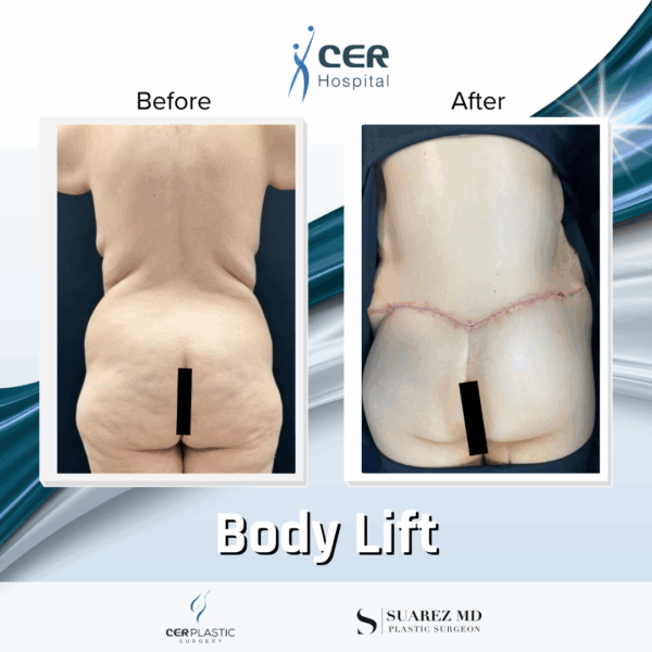 Body Lift - 17064 - Image 6