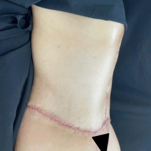 Body Lift – 17064