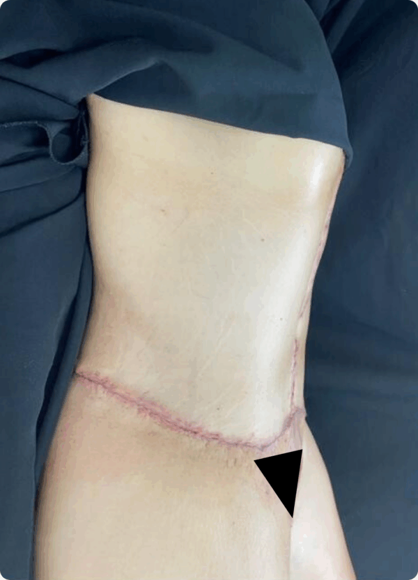 Body Lift - 17064 - Image 2
