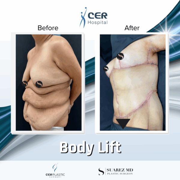 Body Lift -14064 - Image 6