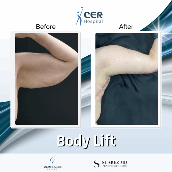 Mini Body Lift - 12064 - Image 6
