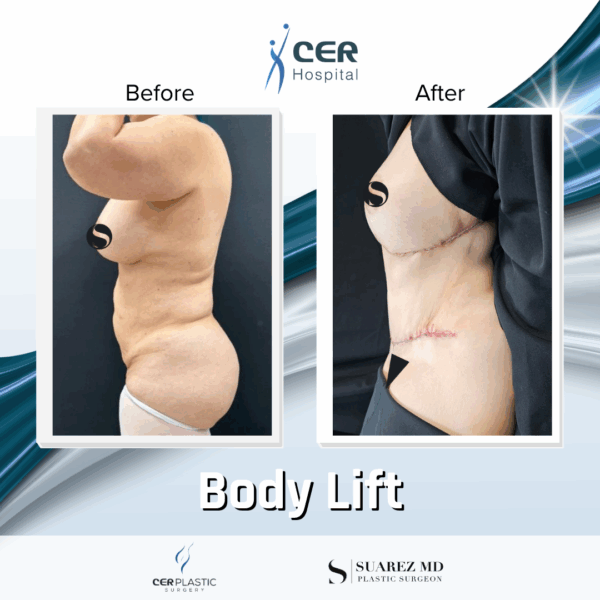 Body Lift and Eyelid Surgery - 5064