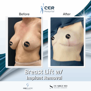 Breast Lift with Implant Removal – 5064