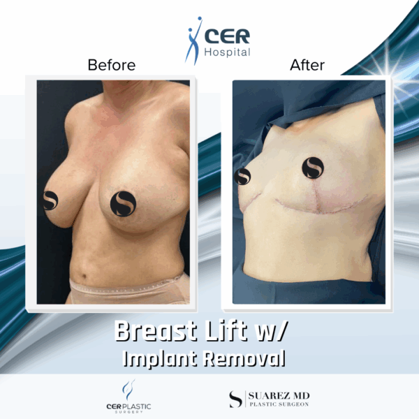 Breast Lift with Implant Removal - 5064