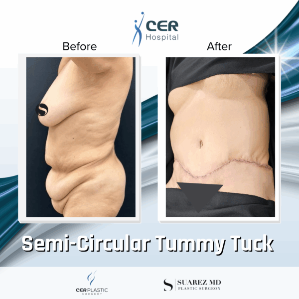Semi Circular Tummy Tuck - 3064 - Image 7