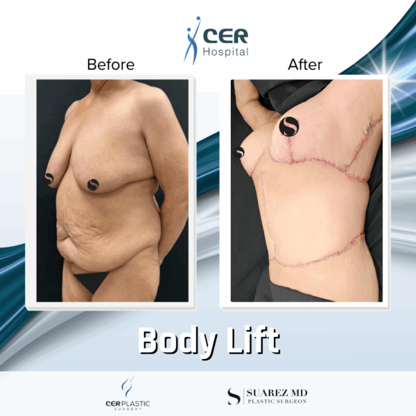 Body Lift - 20054 - Image 7