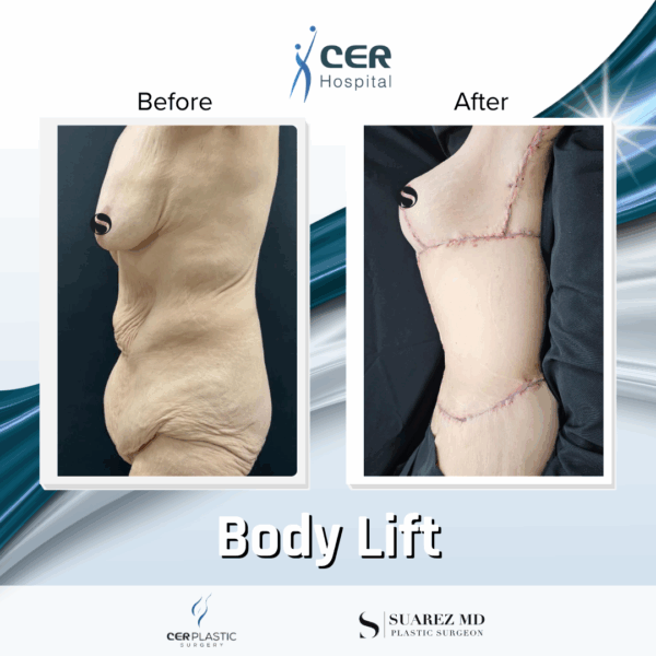 Body Lift - 17054 - Image 6