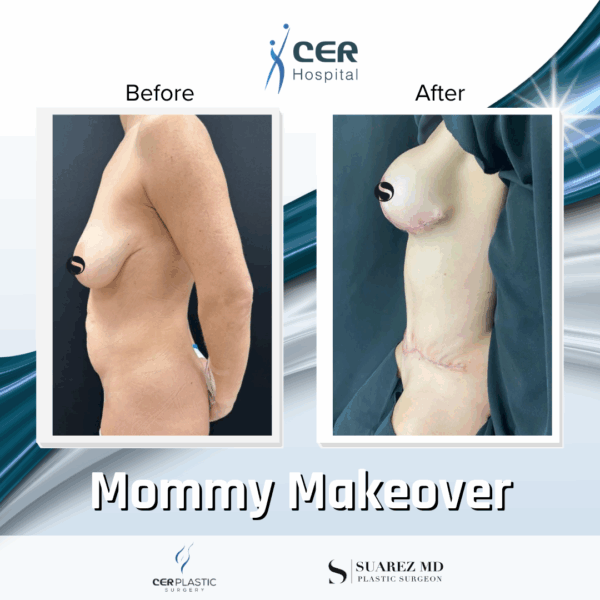 Mommy Makeover - 063 - Image 6