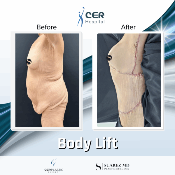 Body Lift - 8054 - Image 7