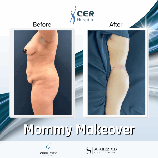 Mommy Makeover - 061 - Image 6