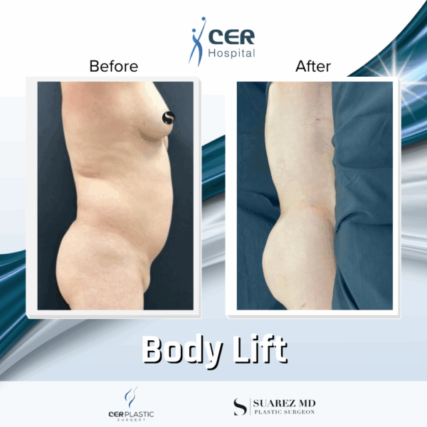 Body Lift - 284 - Image 7