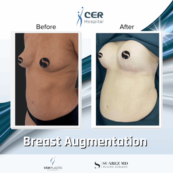 Breast Augmentation - 103 - Image 6