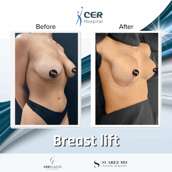 Breast Lift - 103 - Image 6