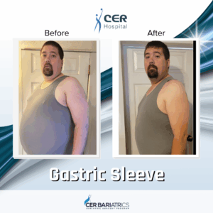Gastric Sleeve