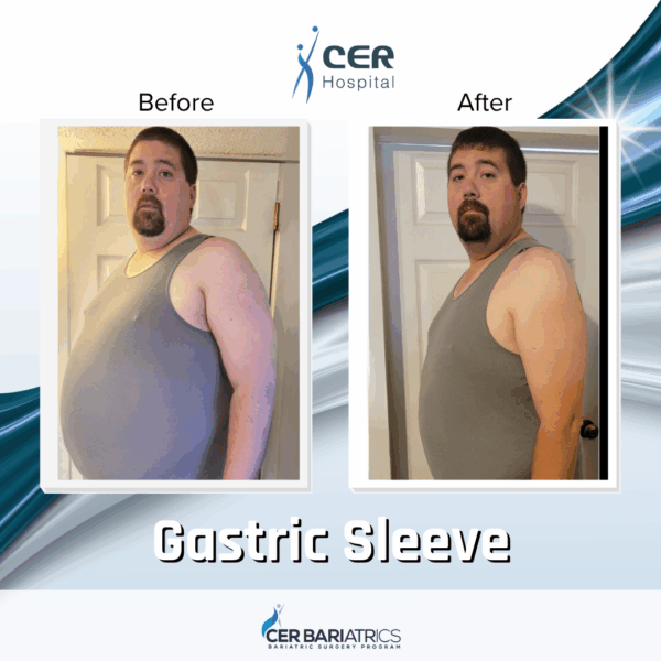 Gastric Sleeve