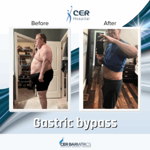 Gastric Bypass