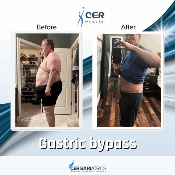 Gastric Bypass - Image 2
