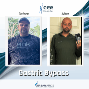 Gastric Bypass