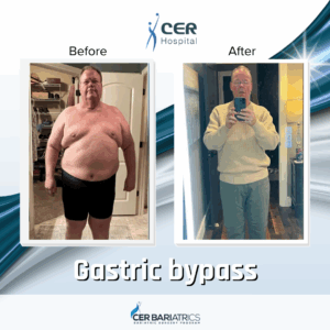 Gastric Bypass