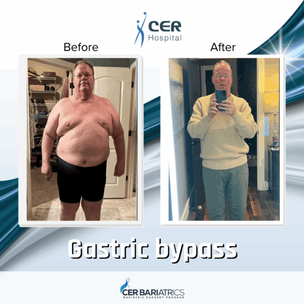 Gastric Bypass