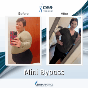 Mini Bypass