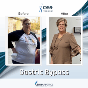 Gastric Bypass