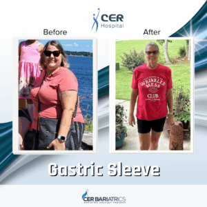 Gastric Sleeve